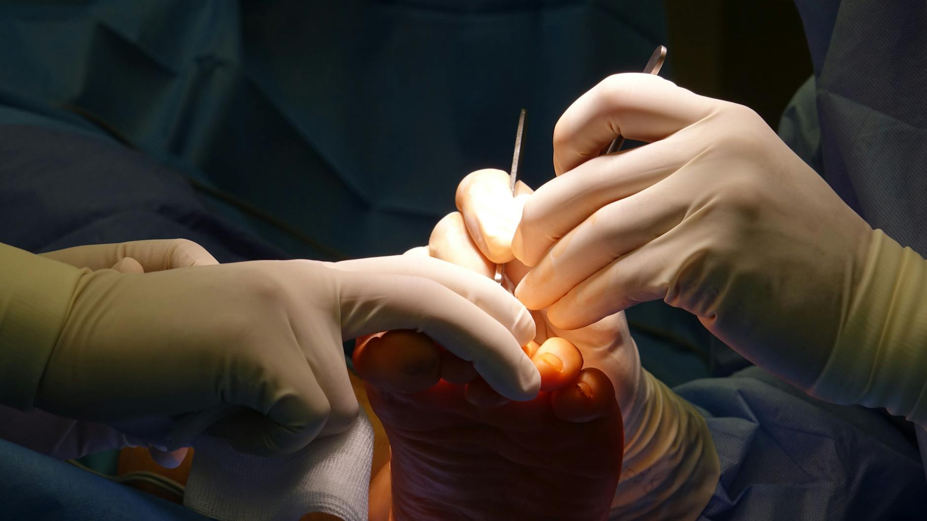 무좀 치료 약 바르는 라미실 효과 및 레이저 치료 실비 적용 팁